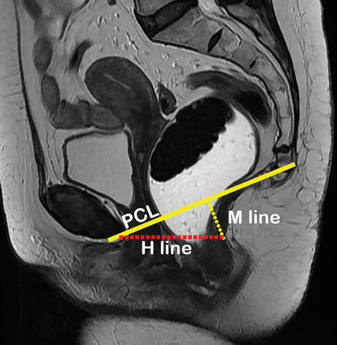 Лобково-копчиковая линия