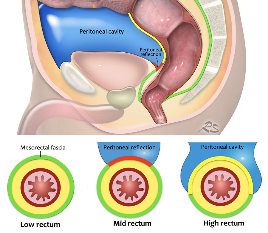 Соотношение мезоректальной фасции и тазовой брюшины